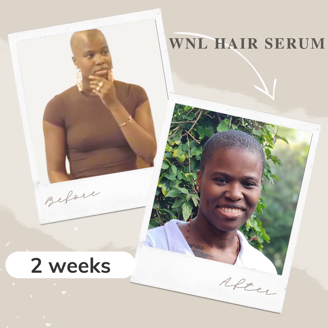 Before and after 2-week hair growth results using WNL Hair Serum, showing visible scalp improvement and healthier hair textur