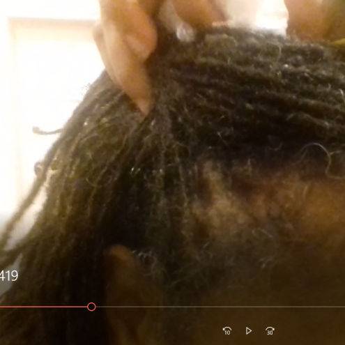 Hairloss before using Tineke&